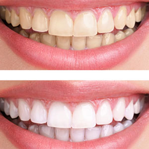 This is the image for the news article titled Teeth Whitening: What is best for you?