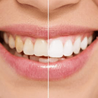 split shot of dental patient of before and after a cosmetic dentistry procedure