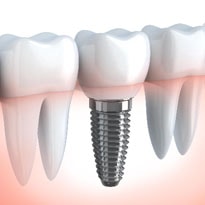 Titanium dental implant close up graphic after placement