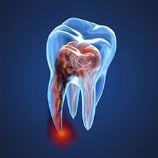 root-canal-therapy-image-of-infected-tooth_225x225