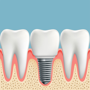 computer drawing of inserted dental implant molar